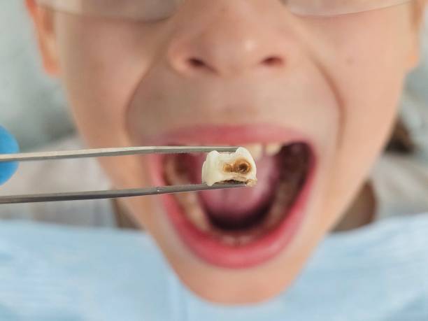 Best Emergency Dentist for Knocked-Out Tooth in Murphys Estates, SC